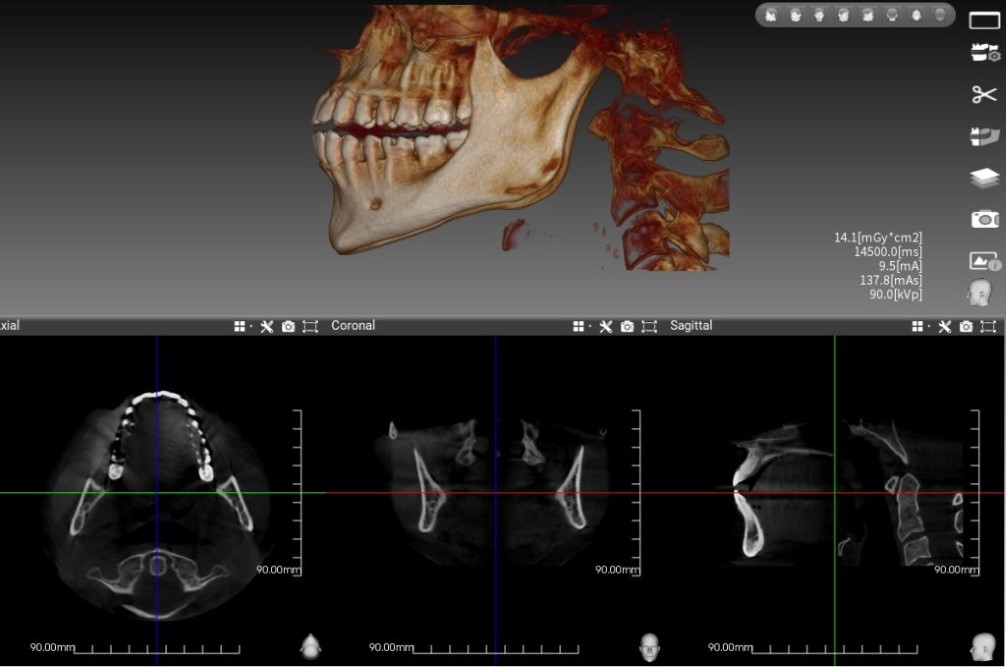 Dental Tomografi Nedir? Avantajları Nelerdir?