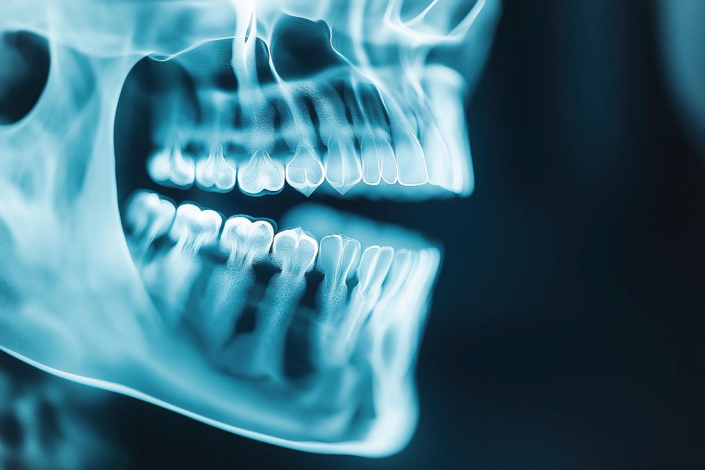 Revaskülarizasyon (Rejeneratif Endodontik Tedavi)