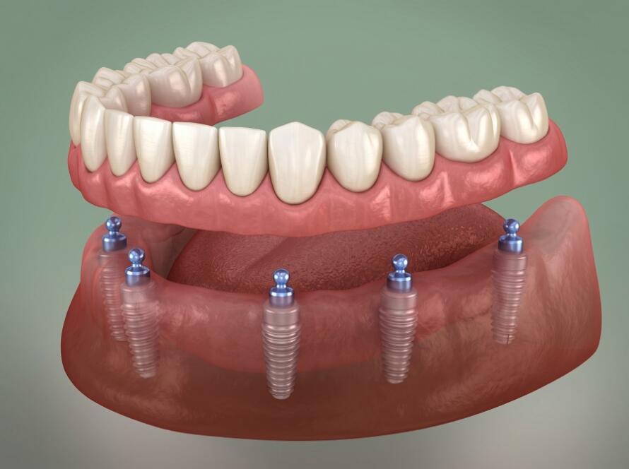 implant üstü protez