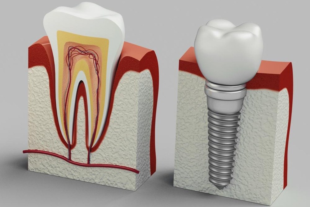 implant ve beslenme