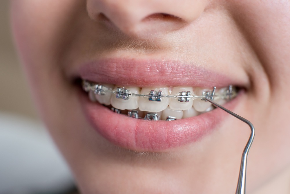 invisalign mı diş teli mi